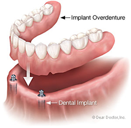 Implant overdenture
